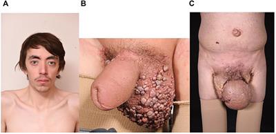 Case Report: Progressive central conducting lymphatic abnormalities in the RASopathies. Two case reports, including successful treatment by MEK inhibition